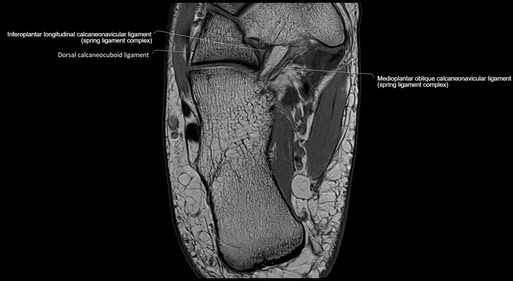 MRI ankle ligaments anatomy axial 3T image 21.webp